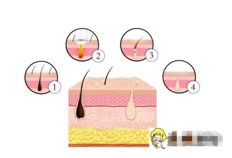 shr冰点脱毛价格如何?有副作用吗?需要注意哪些?“毛桃”女孩必看~