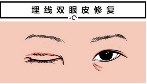 李天石双眼皮修复案例如何?眼整形专家简介!真实案例参考~