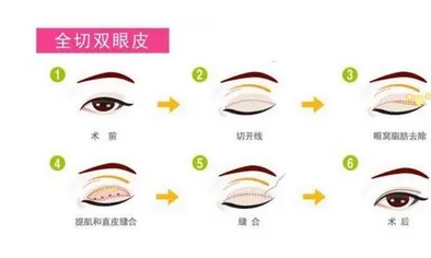 李天石双眼皮修复案例如何?眼整形专家简介!真实案例参考~