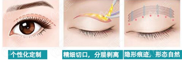 李天石双眼皮修复案例如何?眼整形专家简介!真实案例参考~