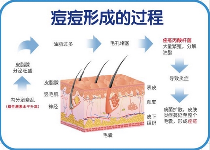 面部痤疮调节方法是什么？痤疮是什么？调节方式及护理盘点！