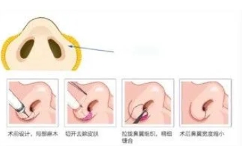 鼻翼缩小的方法是什么？手术原理、注意事项一览！如何护理术后状态？