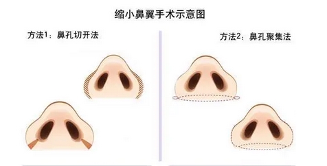 鼻翼缩小的方法是什么？手术原理、注意事项一览！如何护理术后状态？