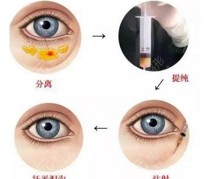 光乳化去眼袋多少钱？多年的眼袋就这样消除了？注意事项有哪些~