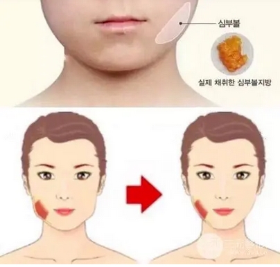 去颊脂垫有副作用吗？运用了哪些原理？去颊脂垫适合哪些人做？