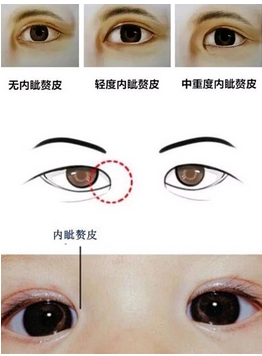 开内眼角好看吗？开内眼角手术方法盘点！注意事项有哪些呢？