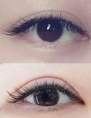 开内眼角好看吗？开内眼角手术方法盘点！注意事项有哪些呢？