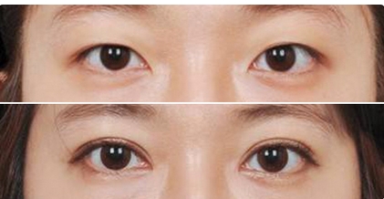 杭州张霞飞双眼皮案例怎么样？医生坐诊排班资料，做手术很有一手哦！