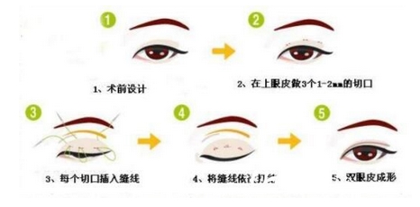 深圳北大医院崔永言双眼皮如何？自然好看又白菜价！心动不如行动啊！