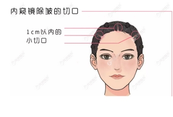 四川省人民医院傅荣额头提拉手术如何?提拉除皱,长久减龄!手术全过程快来看啊~