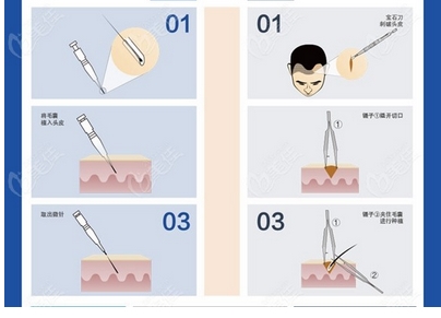 青大附院美容中心微创植发多少钱？科室技术特点在哪里？手术经历分享！