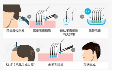 佛山市一毛发种植的费用是多少？真实案例怎么样？还有哪些相关知识需要了解~
