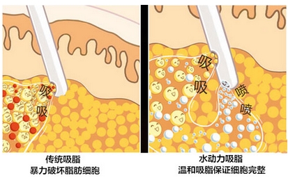 徐州医院整形美容科水动力吸脂瘦身怎么样?医生详细资料介绍!存好钱准备去做了~