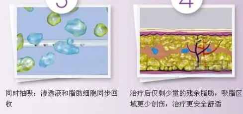 徐州医院整形美容科水动力吸脂瘦身怎么样?医生详细资料介绍!存好钱准备去做了~