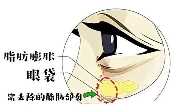 重庆刘正茂医生怎么样？亲身去眼袋经历分享：后悔没早来！