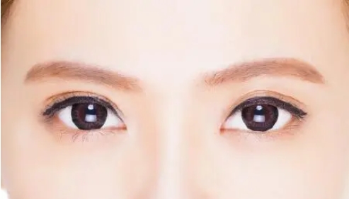 总医院李先慧双眼皮怎么样？防止疤痕增生该怎样做？快来看看案例过程吧！