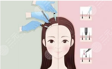 医学科学院整形医院植发怎么样？医生技术实力介绍-案例公开，等你来品鉴！！