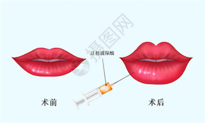 玻尿酸丰唇多少钱一针?玻尿酸丰唇术后注意事项有哪些?