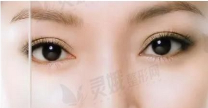吴溯帆双眼皮案例如何？修复果如何_手术特点介绍~附案例分析！