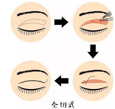 岑瑛双眼皮怎么样?医生团队技术实力怎么样?真实案例可以反映~