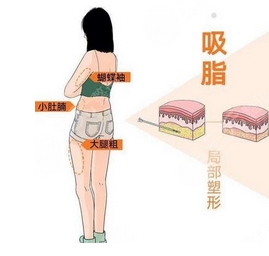 武汉协和医院杨杰医生怎么样?做了吸脂手术后美“炸”了!专家带你了解!
