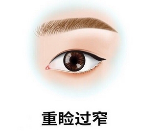 四川省医院傅荣双眼皮怎么样?热门医生|术后点评!待你参考~