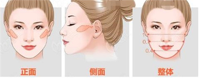 杭州连天美颧骨内推怎么样?技术实力_口碑评价,医院简介详情!