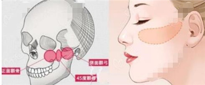 杭州连天美颧骨内推怎么样?技术实力_口碑评价,医院简介详情!