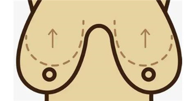 假体隆胸可以哺乳吗，假体隆胸的恢复期是多久呢？