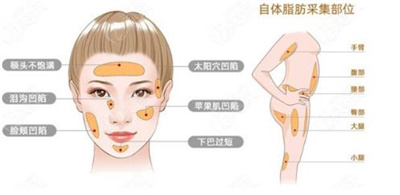 杭州连天美脂肪填充怎么样 ?两位实力派医生介绍,价格表一览!