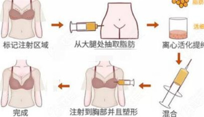 脂肪填充丰胸有风险吗？脂肪丰胸可以维持多久时间？