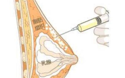 脂肪填充丰胸有风险吗？脂肪丰胸可以维持多久时间？