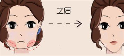 姜陶然瘦脸案例分享,术后的形象真的惊呆了,轮廓好美!