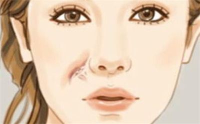 激光疤痕修复效果图,术后的形象让我大吃一惊!