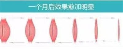 小腿吸脂会有效果吗？术后会不会反弹？吸脂手术对身体会伤害吗？