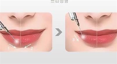 玻尿酸丰唇需要多少钱？能维持多久的时间？