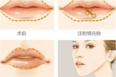玻尿酸丰唇需要多少钱？能维持多久的时间？