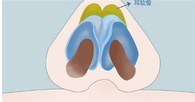 隆鼻手术多久恢复自然，隆鼻手术存在风险吗？