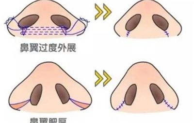 余文林医生做鼻子怎么样?医生介绍,假体隆鼻案例分享!