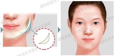 云南省第一人民医院颌面外科做下颌角整形手术怎么样?手术反馈送达,附科室医生详细介绍!