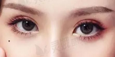 四川省人民医院张家建医生双眼皮/祛眼袋怎么样？医生怎么样？双眼皮案例公开！