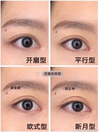 西京医院崔江波医生做什么双眼皮风格多?技术好吗?真实案例发布一下!