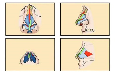 北京八大处王欢案例图片分享,丑女的蜕变之旅变化惊人!