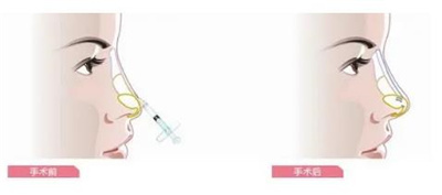 北京八大处王欢案例图片分享,丑女的蜕变之旅变化惊人!