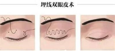隋长清的双眼皮做得怎么样?案例公开,2023年价格表更新!