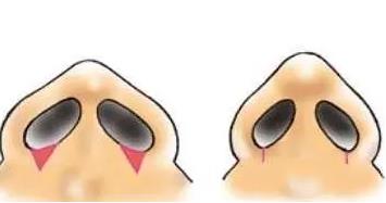 鼻头鼻翼缩小术价格贵吗?价格的高低和哪些因素有关呢?戳进来看详情