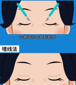 高分子埋线双眼皮多少钱?价格贵不贵?术后如何护理?