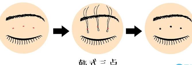 高分子埋线双眼皮多少钱?价格贵不贵?术后如何护理?