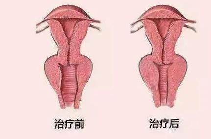 紧缩术有用吗?效果可维持多久呢?注意事项介绍