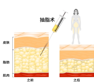 武汉协和郭科抽脂怎么样?口碑好吗?医生信息简介-大腿抽脂病例!